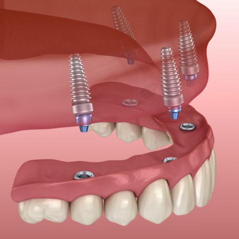 implants-1