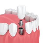 implants-5