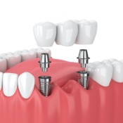 implants-6